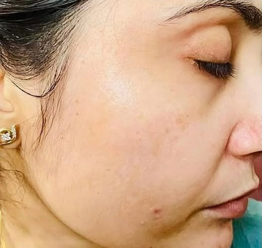 Glass Skin Using Ayurveda Kerala Routine That Works