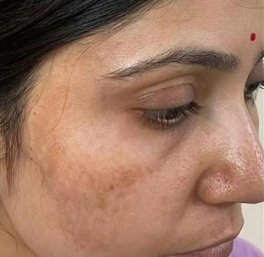 How to Treat Melasma Naturally with Kerala’s Golden Oil