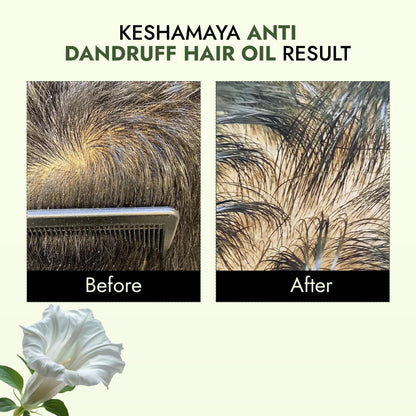 Keshamaya - Anti Dandruff Hair Oil